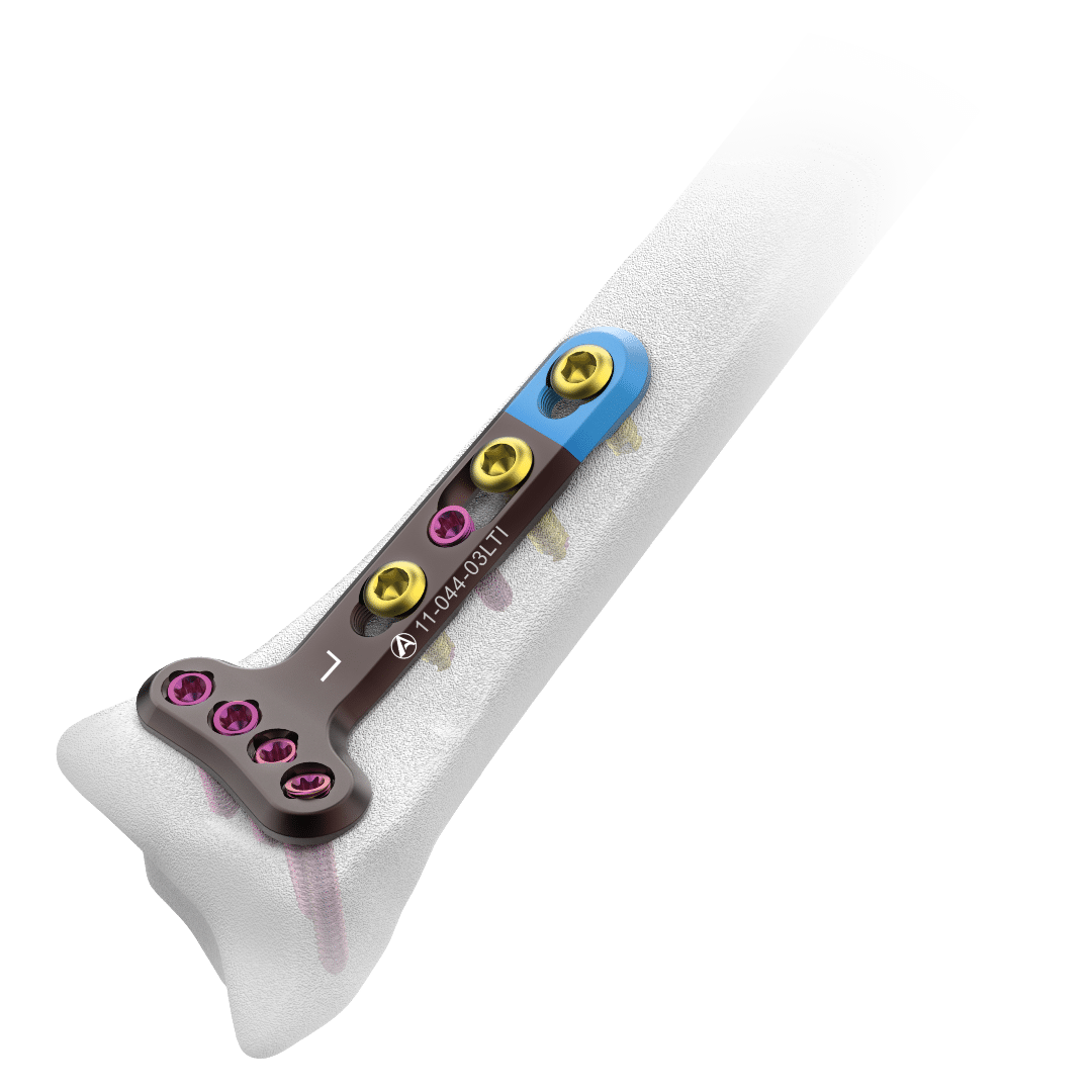 2.4mm-AV-Wiselock-Distal-Radius-Volar-Plate-Extra-articular