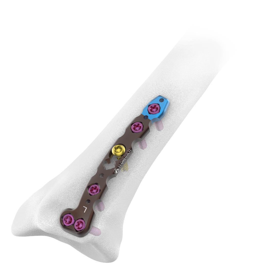 2.4mm-AV-Wiselock-Dorsal-Distal-Radius-Plate-Intermediate-Column