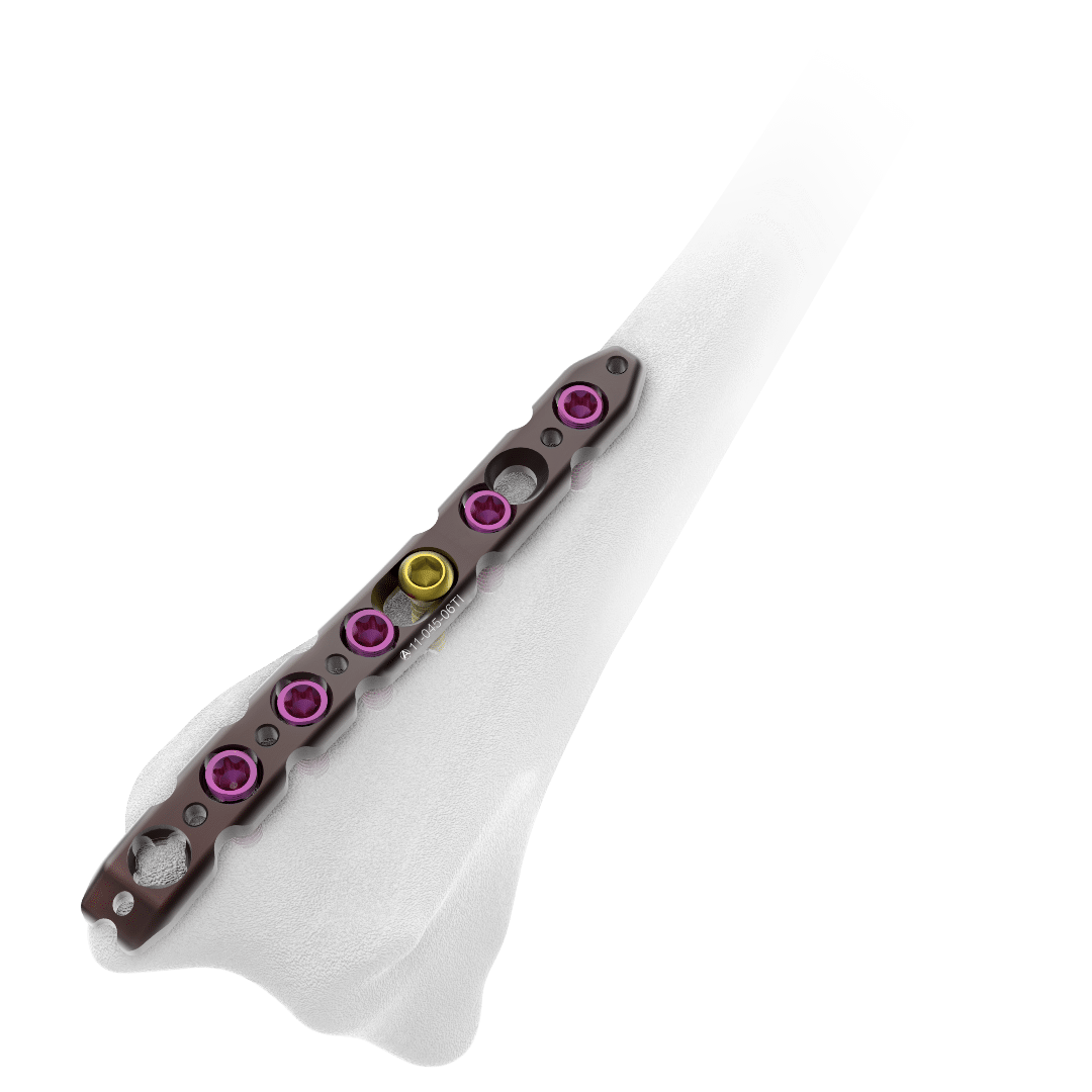 2.4mm-AV-Wiselock-Dorsal-Distal-Radius-Plate-Radial-Column
