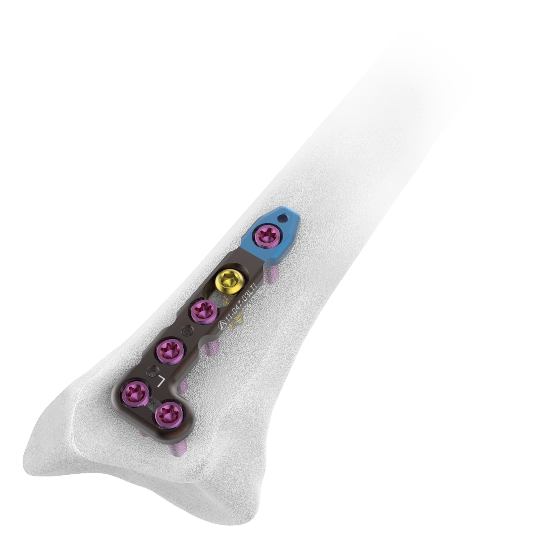 2.4mm-AV-Wiselock-L-Dorsal-Distal-Radius-Plate-2-Head-Holes